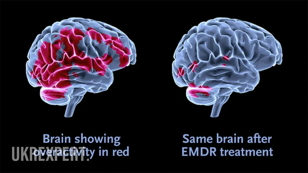 У ВООЗ Emdr назвали кращим методом для лікування психотравм